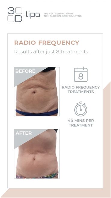 Minimally invasive procedure, tightens skin & improves tone without pain or downtime radio frequency