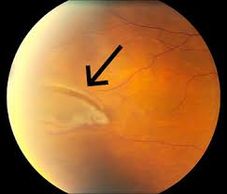 Retinal tear