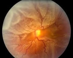 Retinal detachment