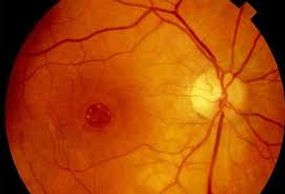 Macular hole