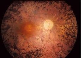 Retinitis pigmentosa