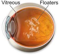 Vitreous floaters