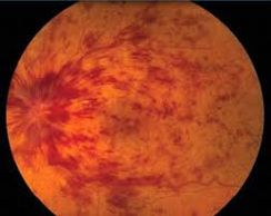 Retinal vein occlusion