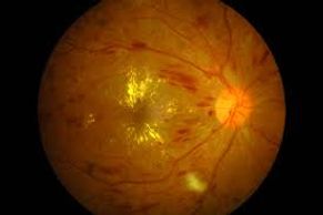Diabetic eye disease