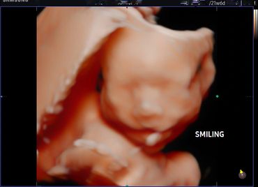 3D 4D fetal ultrasound at 21 weeks Memories In 4D Medina Ohio