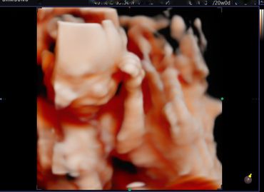 3D 4D fetal ultrasound at 20 weeks Memories In 4D Medina Ohio