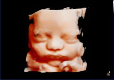 3D 4D fetal ultrasound at 34 weeks Memories In 4D Medina Ohio