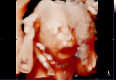 3D 4D fetal ultrasound at 21 weeks Memories In 4D Medina Ohio