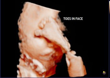 3D 4D fetal ultrasound at 32 weeks Memories In 4D Medina Ohio
