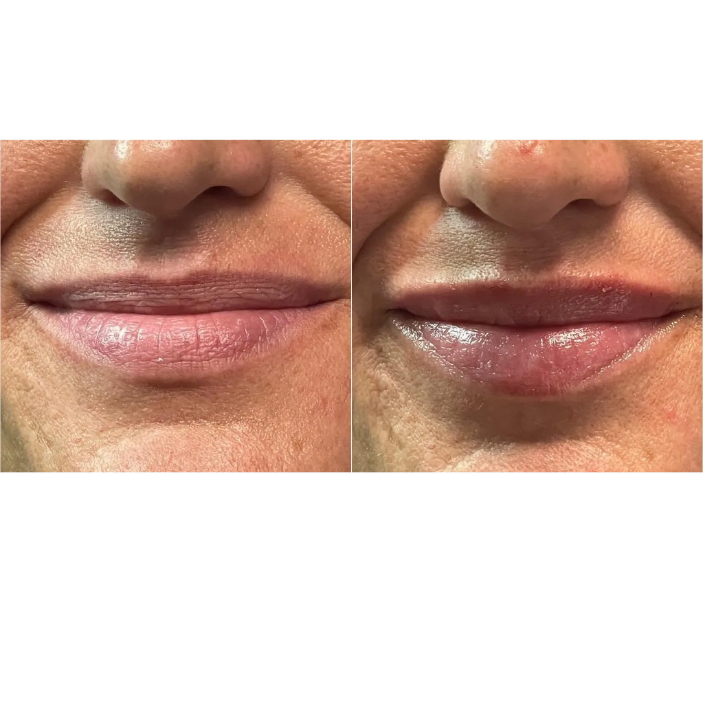 Lip Filler  - Located in Joplin, MO