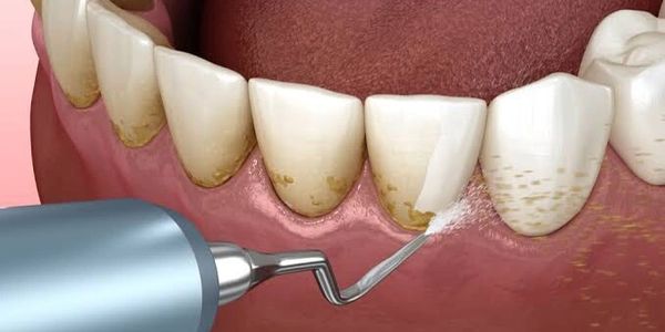 Teeth Cleaning & Polishing in Lucknow
Dr Akhil Agarwal MDS (KGMU) Dentist Orthodontist Dental Clinic