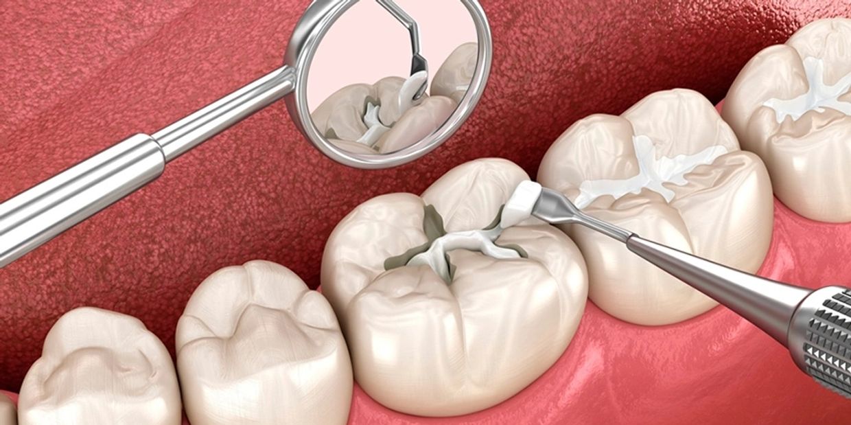Dental Fillings for decayed teeth.
Dr Akhil Agarwal MDS (KGMU)- Dentist Orthodontist Clinic Lucknow.