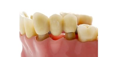 Dental Crown and Bridge Lucknow