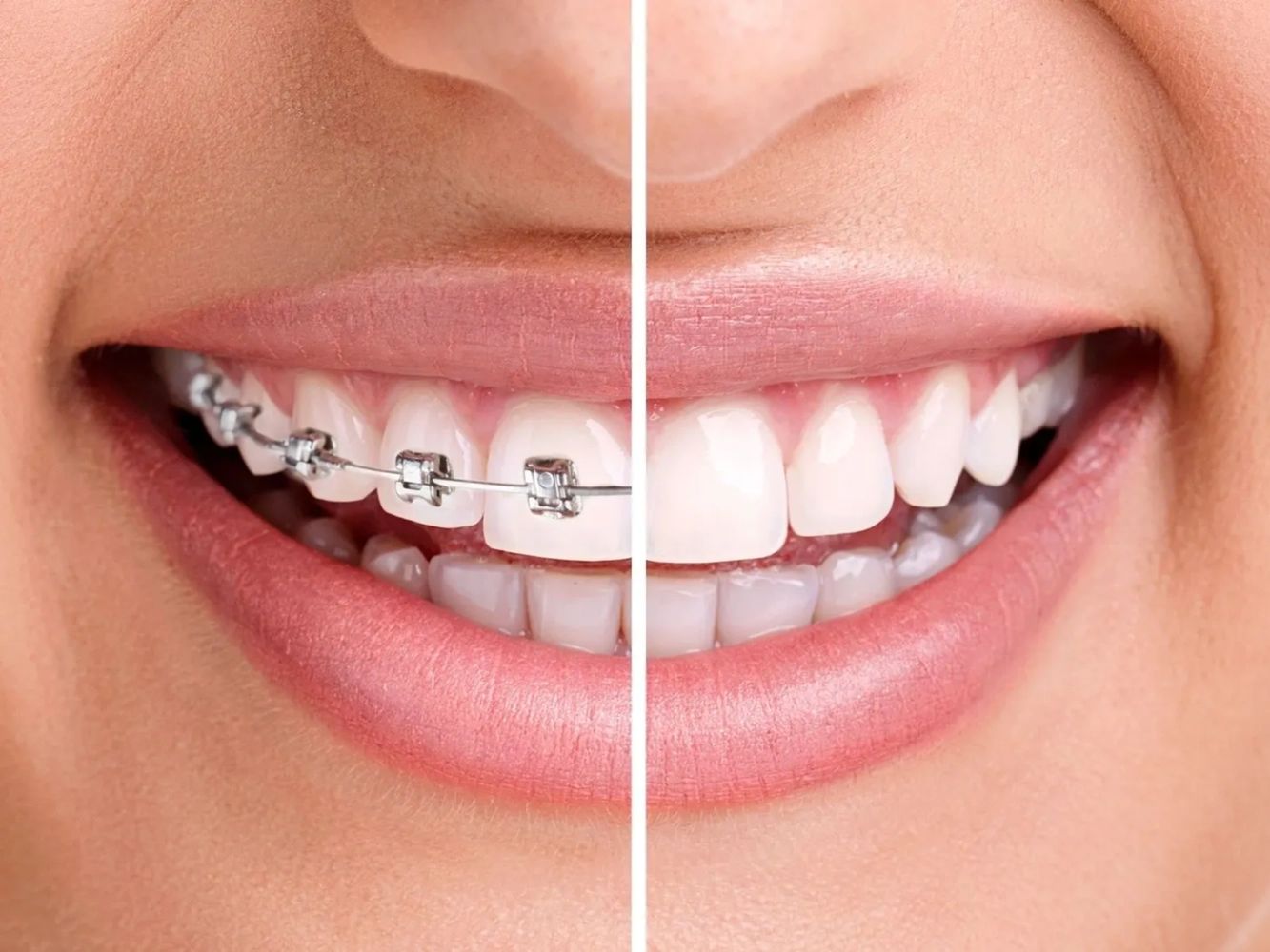 Smile with fixed dental braces 