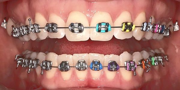 Dr Akhil Agarwal MDS (KGMU)- Dentist Smile Orthodontist in Lucknow Dental Metal Braces Invisalign Al