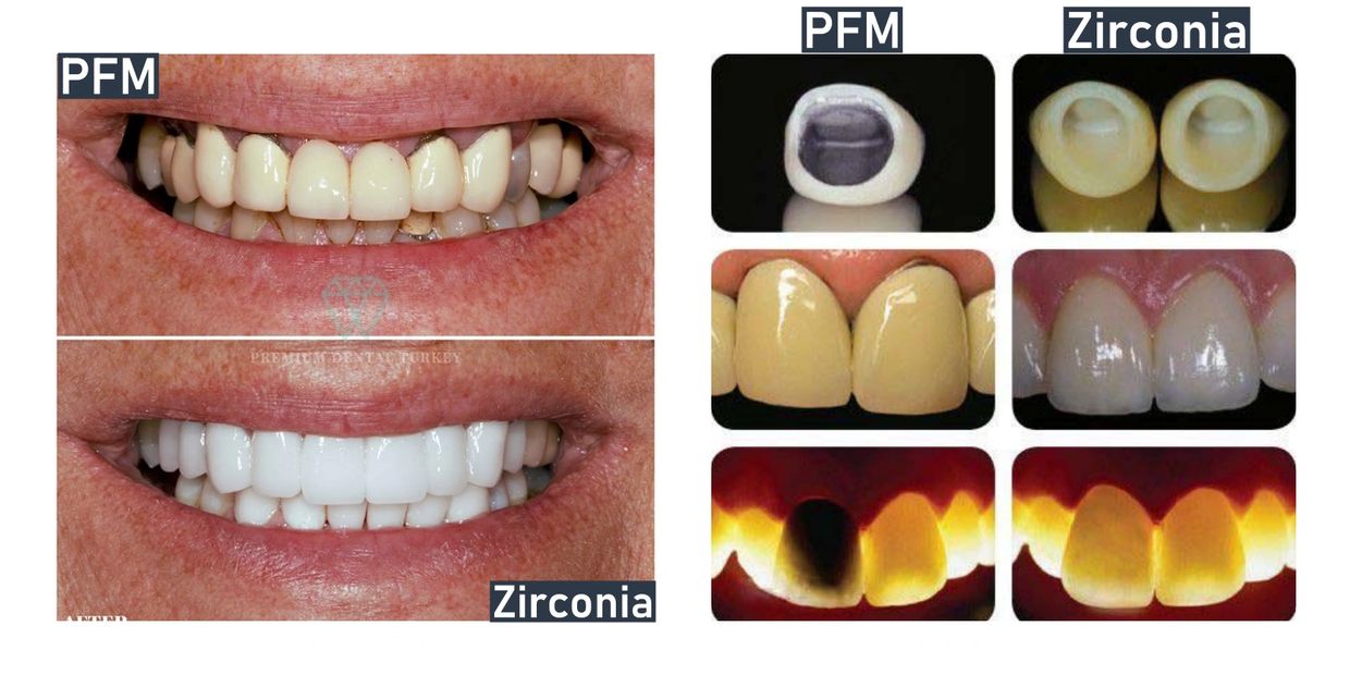Comparison of PFM versus Zirconia Dental Crown and Bridge Lucknow
