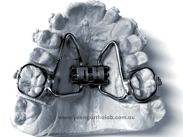 Banded RME with Buccal Tube
