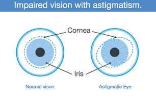 Astigmatism