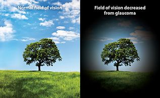 Glaucoma vision changes