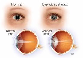 Cataract diagram