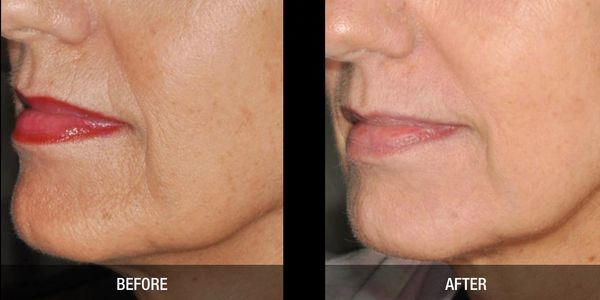 Skin resurfacing anti ageing lines and wrinkle 