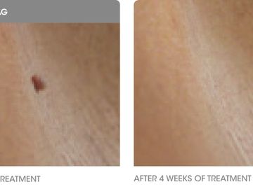 skin tag and wart removal