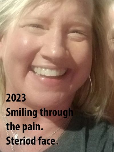 Woman smiling despite pain, showing signs of steroid face.