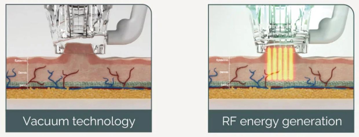 Pro-Lift RF microneedling flagstaff