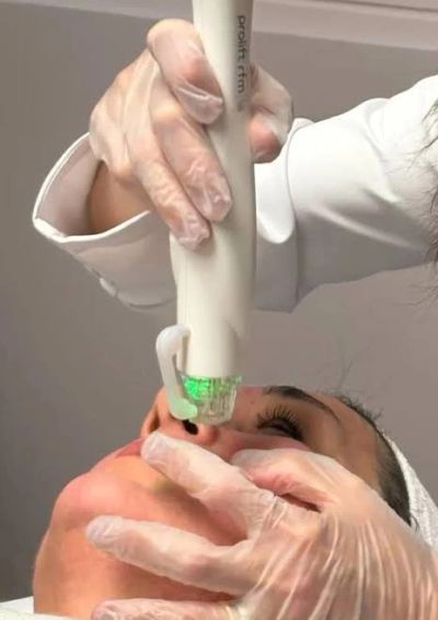 Vacuum lifting skin to Microneedle with radiofrequency