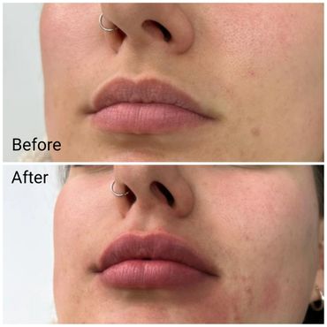 lip filler southampton