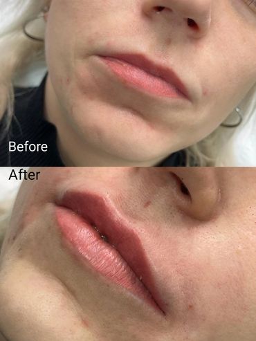 lip filler southampton