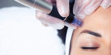microneedling southampton