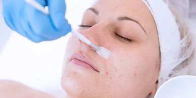 chemical peel southampton