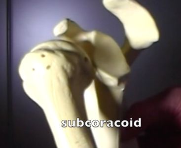 subcoracoid dislocation anatomy