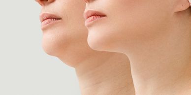 Aqualyx chin fat dissolver @ Real Health & Aesthetics in Mid Sussex realaesthetic. co.uk