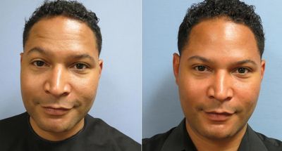 HA filler in cheeks and temples by Dr. Marla Klein MD, BC-Dermatologist