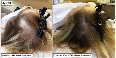 Keravive treatments available at Klein Dermatology & Associates for hair loss.