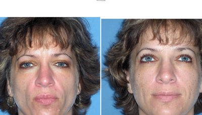 Sculptra in progress by Dr. Marla Klein, Klein Dermatology & Associates