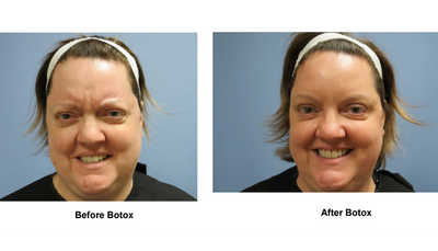 Botox Glabella and Crow's feet