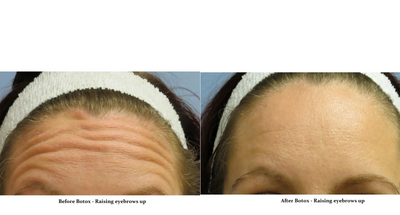 Botox forehead