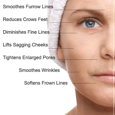Parts of face that microneedling helps