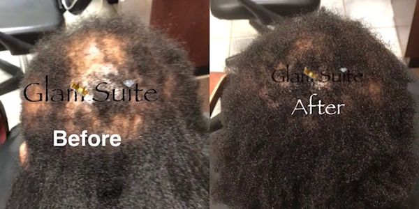 Real hair growth results for black women with hair loss using Glam Suite products.
Also check out the e-book "Growing Hair A Methodical Approach To Reducing & Reversing Hair Loss" this book will help restore your hair.