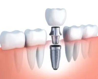 dental-implant-specialist-sioux-falls-sd