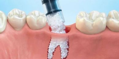 sioux-falls-dental-implant-center-kevin-haiar-bone-grafting