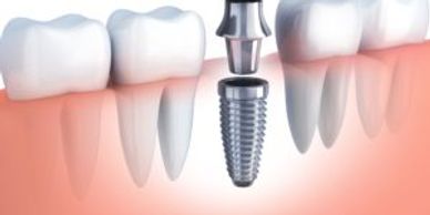 sioux-falls-dental-implant-center-dental-implants-kevin-haiar
