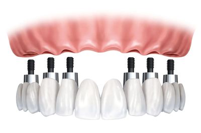 fixed-implant-teeth-sioux-falls-sd