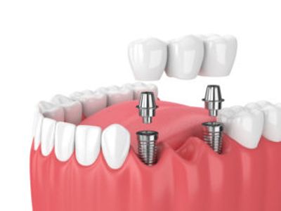 sioux-falls-sd-dental-implant-bridges
