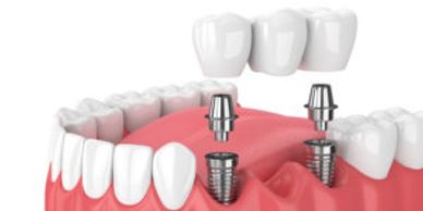 sioux-falls-dental-implant-center-kevin-haiar-dental-implant-supported-bridges