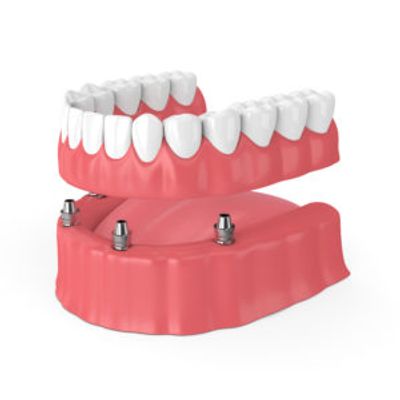 implant-dentures-sioux-falls-sd