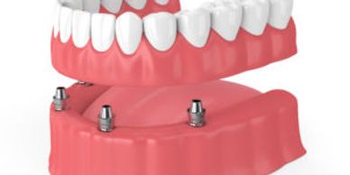 sioux-falls-dental-implant-center-kevin-haiar-dentures